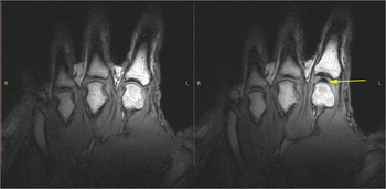 Gas Cavity in the MCP Joint after Knuckle Cracking